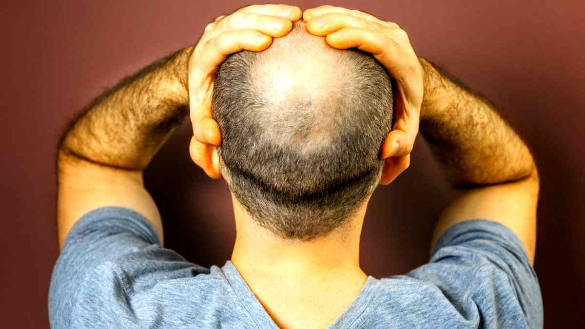 Best Hair Loss Cure for Men