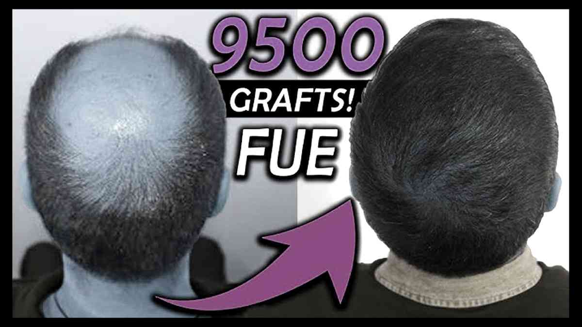 Medical Hair Restoration